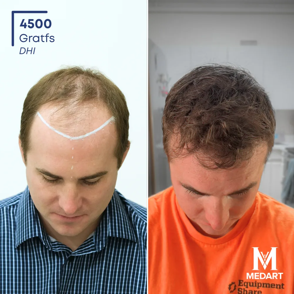 Weldon Rogers DHI-haartransplantatie voor-en-na-foto 2, 4500 grafts bij Medart Hair