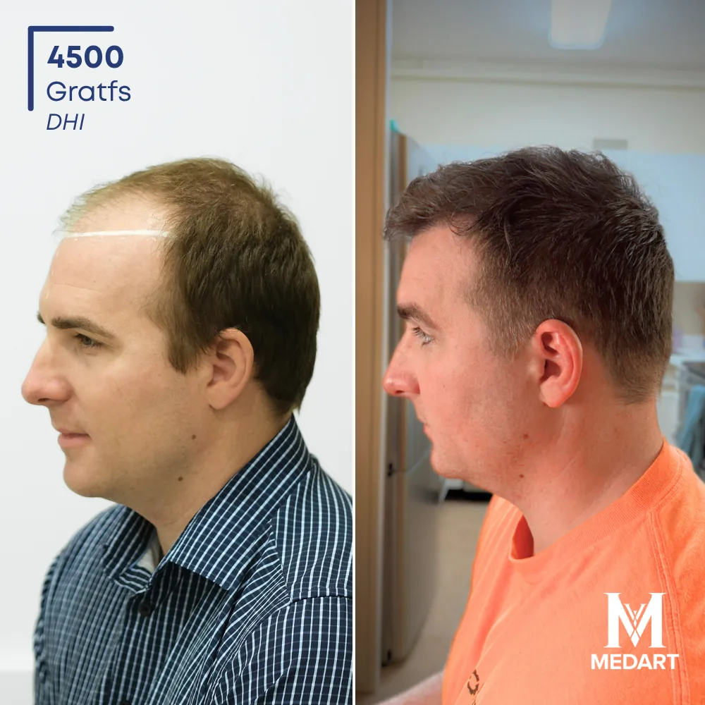 Weldon Rogers DHI-haartransplantatie voor-en-na-foto 3, 4500 grafts bij Medart Hair