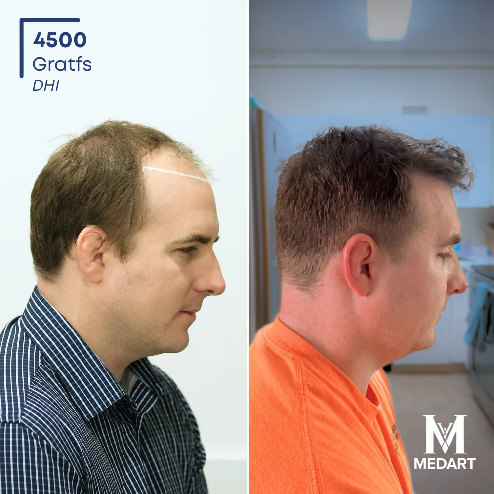 Weldon Rogers DHI-haartransplantatie voor-en-na-foto 4, 4500 grafts bij Medart Hair