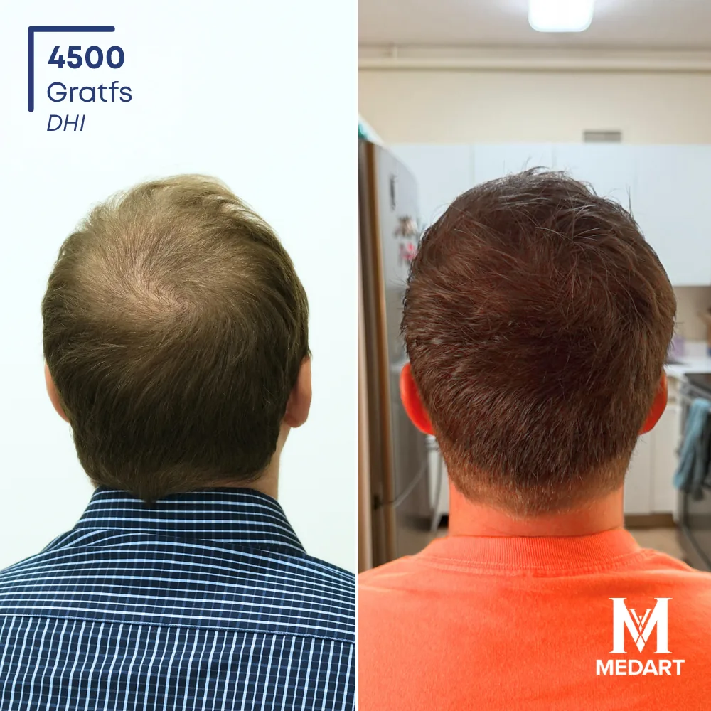 Weldon Rogers DHI-haartransplantatie voor-en-na-foto 5, 4500 grafts bij Medart Hair
