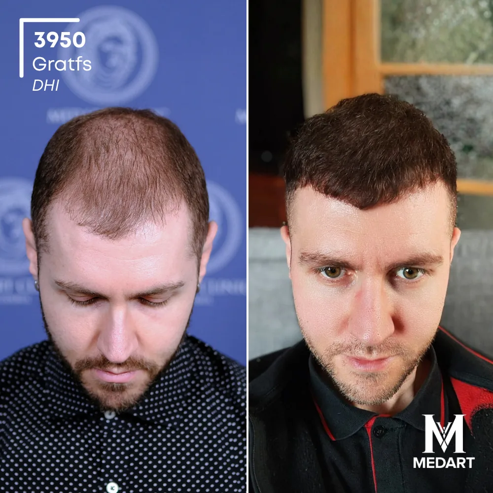 Nicolo Zugnoni DHI-haartransplantatie voor-en-na-foto 2, 3950 grafts bij Medart Hair