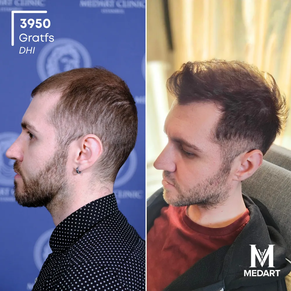 Nicolo Zugnoni DHI-haartransplantatie voor-en-na-foto 3, 3950 grafts bij Medart Hair
