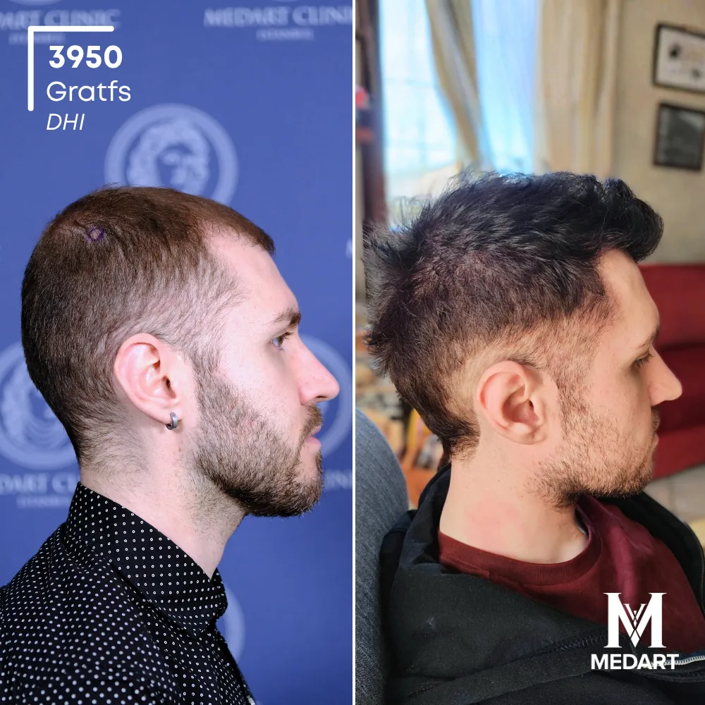 Nicolo Zugnoni DHI-haartransplantatie voor-en-na-foto 4, 3950 grafts bij Medart Hair