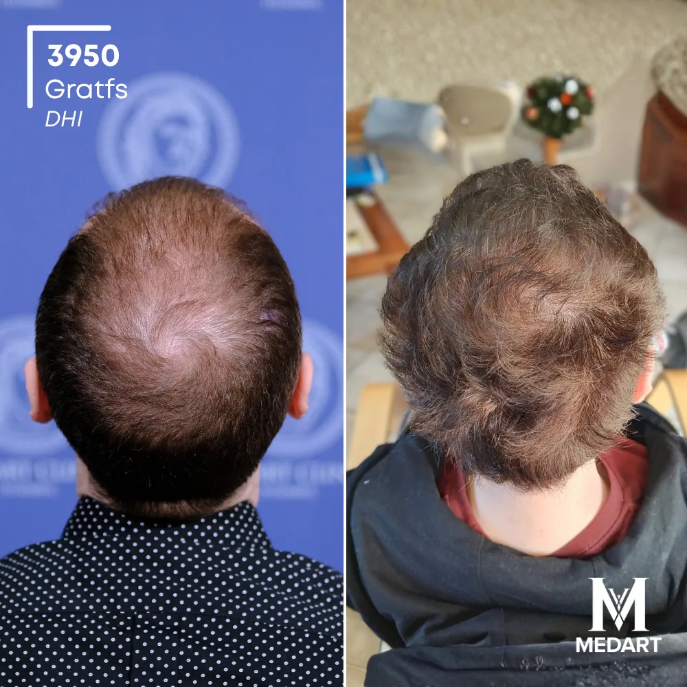 Nicolo Zugnoni DHI-haartransplantatie voor-en-na-foto 5, 3950 grafts bij Medart Hair