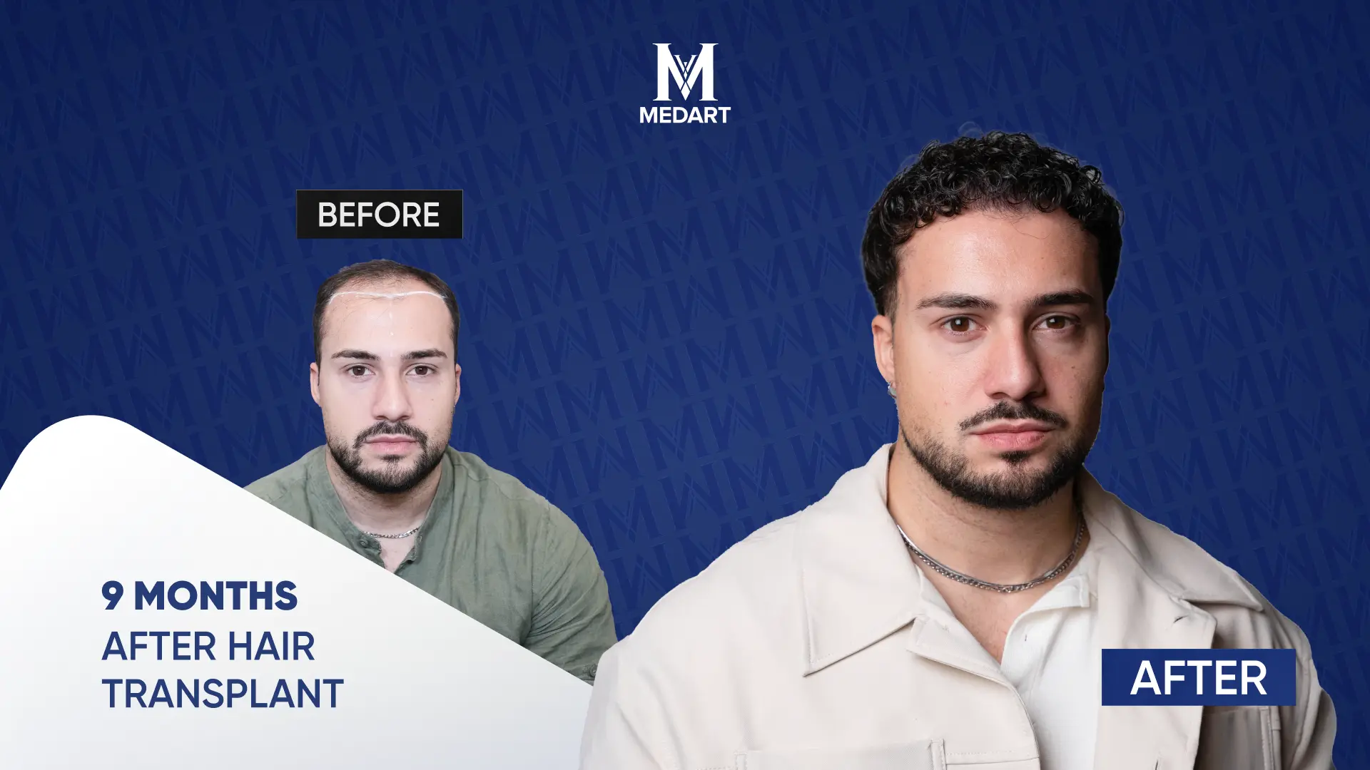 Hair transplant in Turkey at MedArt Hair Istanbul