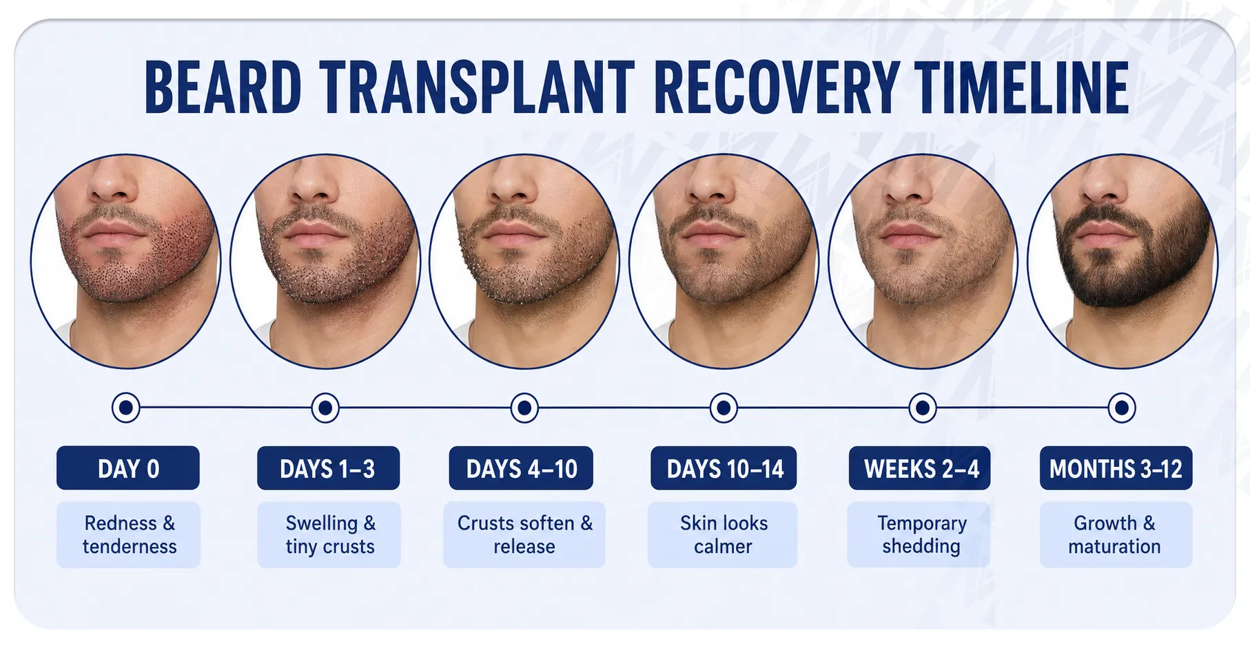 Cronograma infográfico de las etapas de cicatrización del trasplante de barba desde costras hasta desprendimiento hasta recrecimiento.