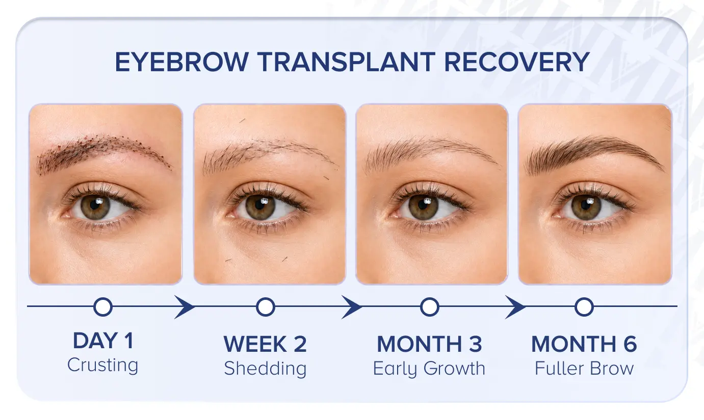 Cronograma de recuperación del trasplante de cejas mes a mes mostrando desprendimiento y luego recrecimiento.
