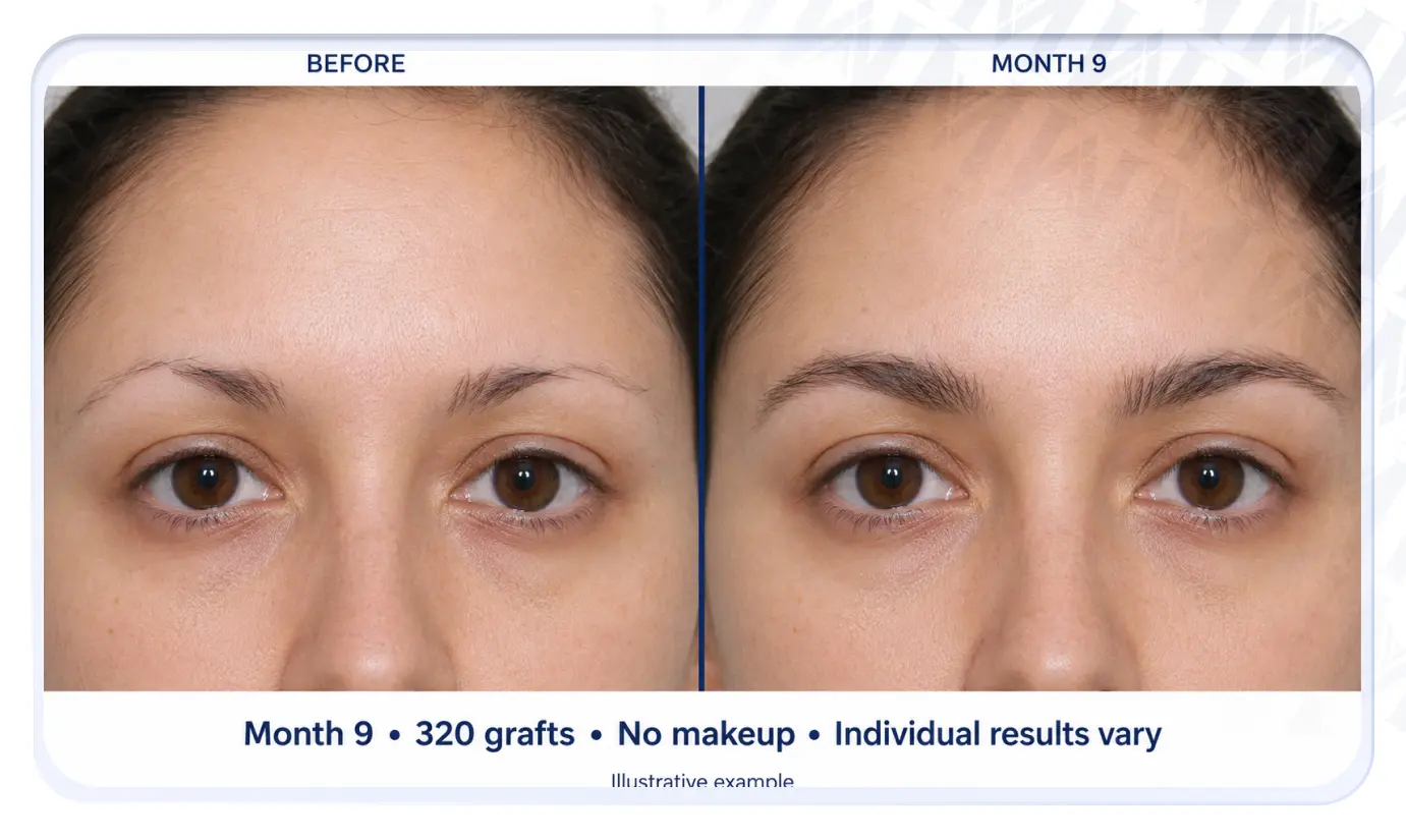Resultado de trasplante de cejas a los nueve meses, 320 injertos, sin maquillaje, los resultados individuales varían