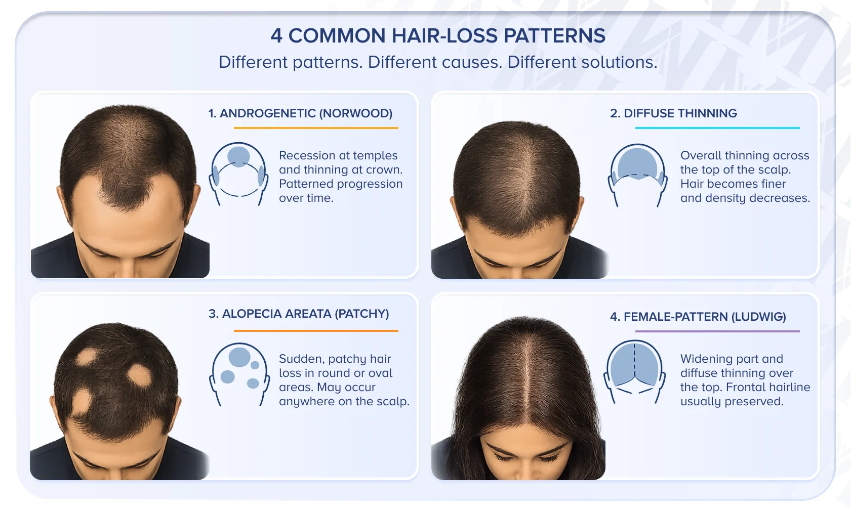 Illustrazione medica che mostra la caduta dei capelli patterned, diffusa, a chiazze e femminile con distribuzioni visibili distinte.