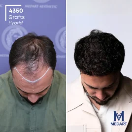 Before hair transplant showing thinning hair