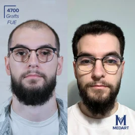 FUE Hair transplant turkey before after 3