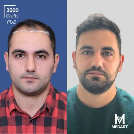 FUE Hair transplant turkey before after 2