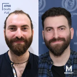 FUE Hair transplant turkey before after 1
