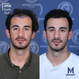 FUE Hair transplant turkey before after 4