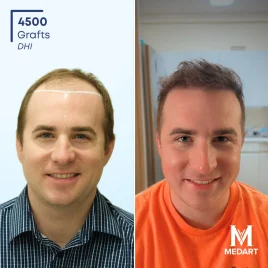 Before and after hair transplant showing improved hair density