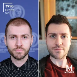 Before hair transplant showing Norwood 3 hair loss